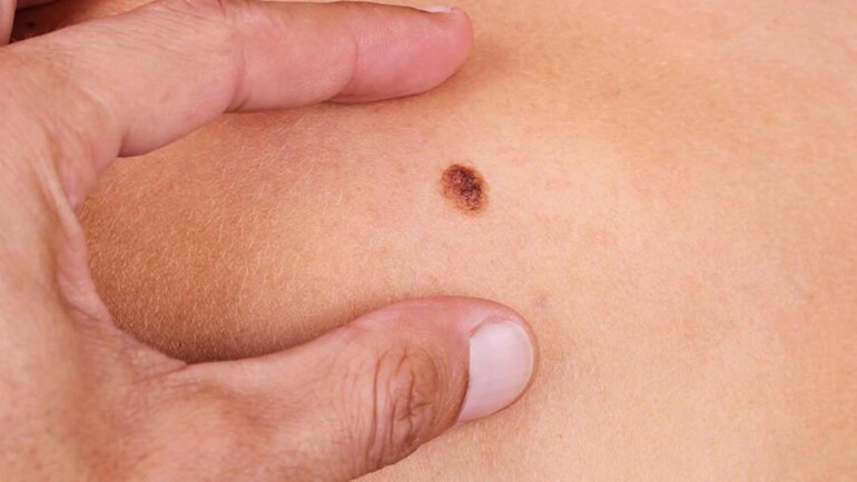 Το πρώτο τεστ για το μελάνωμα του δέρματος που εντοπίζει όσους δεν κινδυνεύουν με μετάσταση του καρκίνου